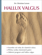 Hallux valgus